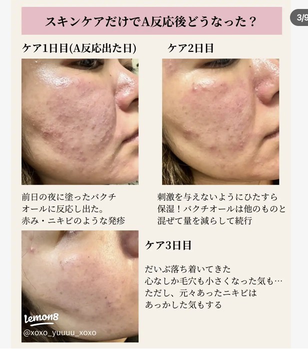 レチノールを超える?注目の次世代レチノール成分を化粧品研究者が徹底解説 | Beauty Science News