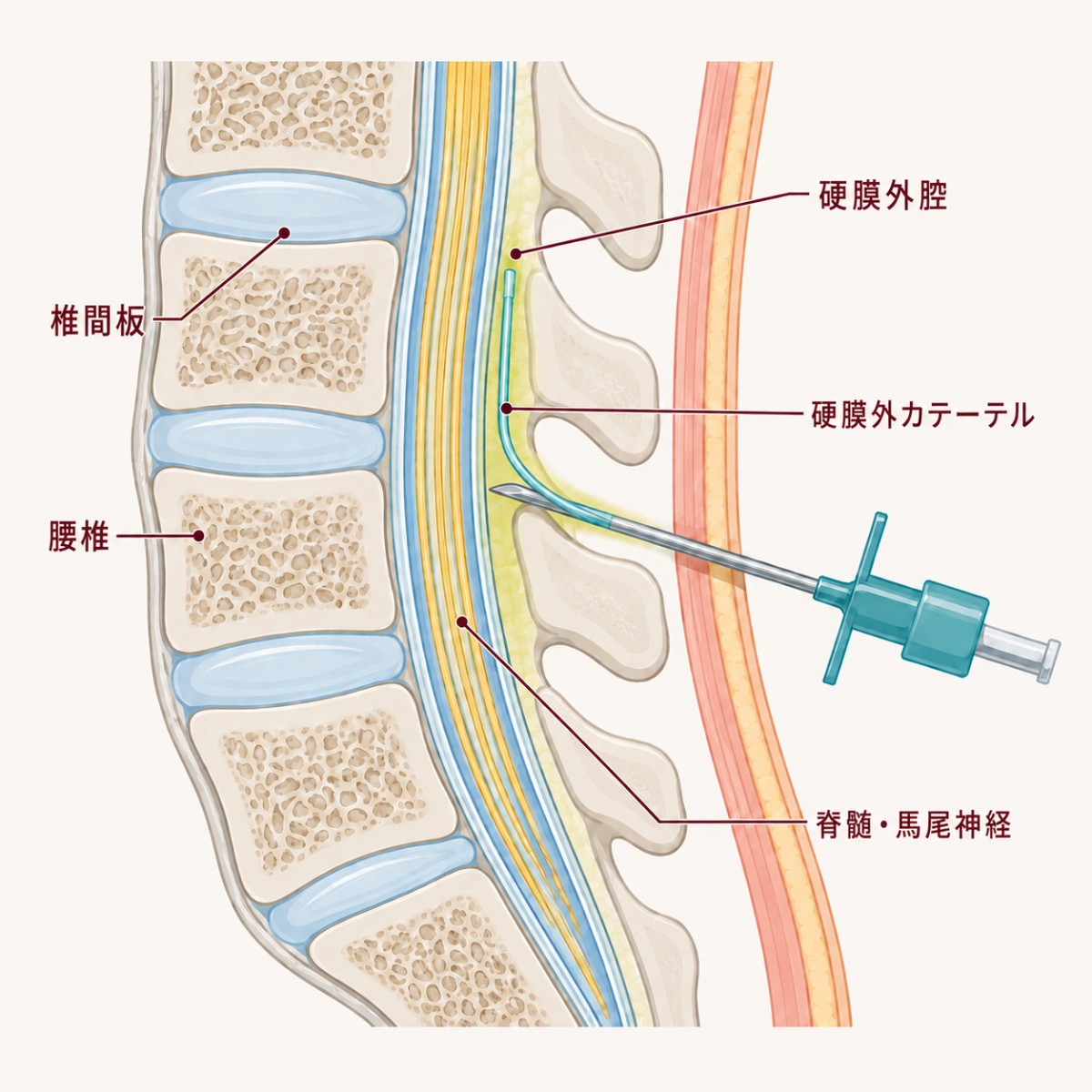 「硬膜外鎮痛」のイメージ。生成AIで著者作成。