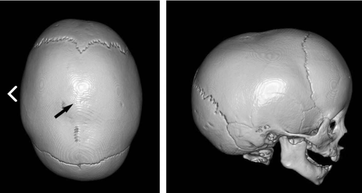 赤ちゃんの頭の形〜わかっていること① ふらいと先生のニュースレター