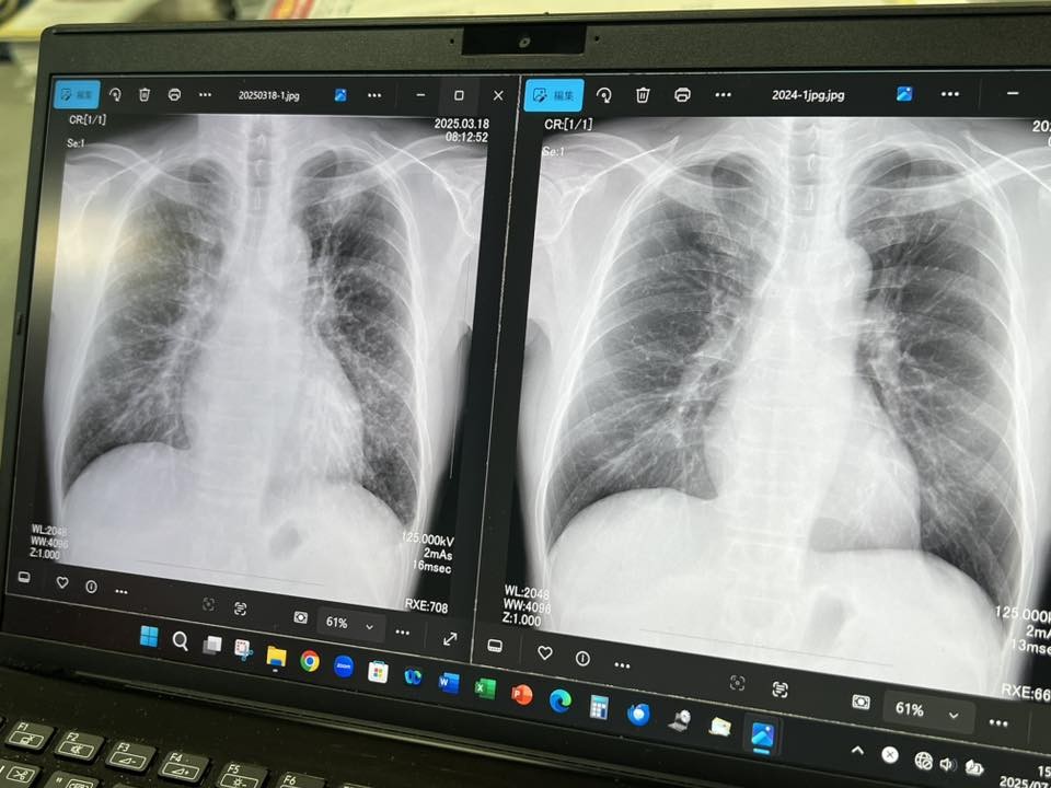 松田さんの肺のX線写真。左が今年ので、昨年の写真（右）にはない、左鎖骨に重なった肺がんと、両肺にも多くの小さい粒状の影が見える。