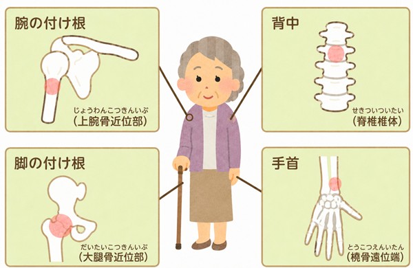 みんなの介護『骨粗鬆症とは?治療薬や予防法を解説』をもとに改変
