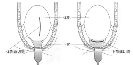 出典：杉本充弘 "古典的帝王切開術" 産科と婦人科 76(suppl): 55-60, 2009.