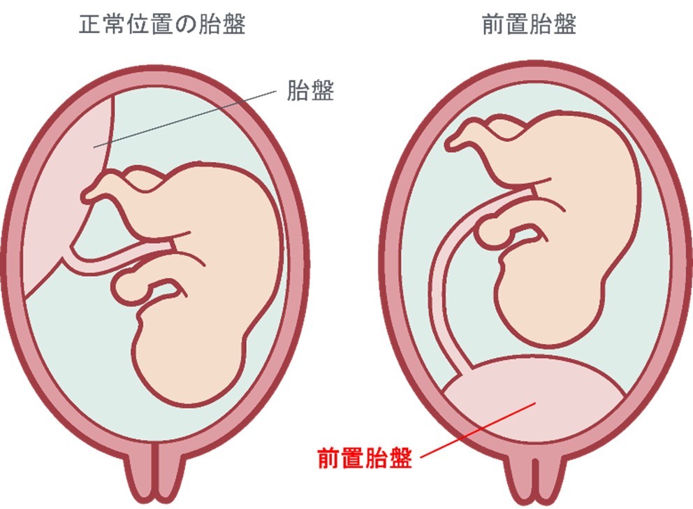 出典:日本産科婦人科学会「前置胎盤」